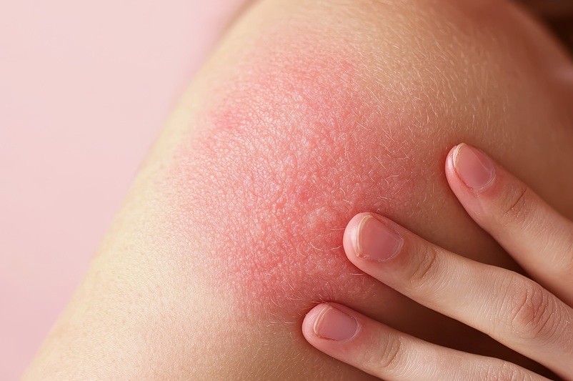 Erytrodermia – co to za choroba i dlaczego może być groźna?