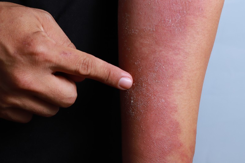 Erytrodemia łuszczycowa – groźna postać łuszczycy