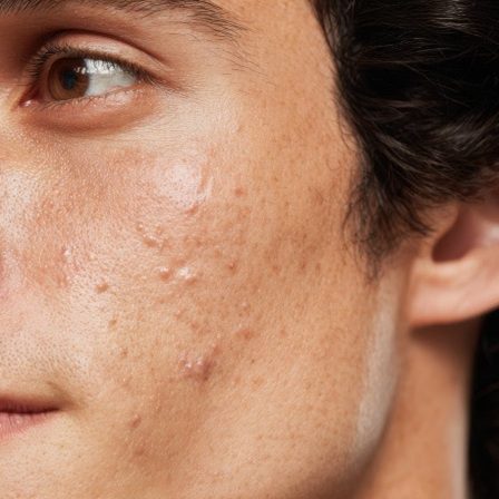 Trądzik u dorosłych