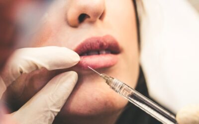 Powiększanie ust kwasem hialuronowym – fakty, mity i odpowiedzi na najczęstsze obawy