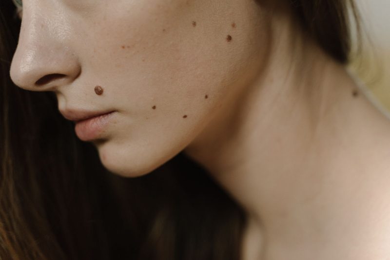 Dermatoskopia – kiedy warto zbadać znamiona i jak przebiega wizyta u dermatologa